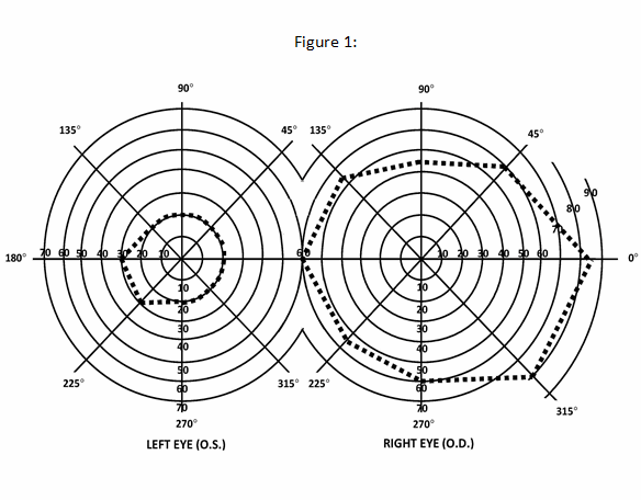 1. Diagram of right eye illustrates extent of normal visual field as tested on standard perimeter at 3/330 (3 mm. white disc at a distance of 330 mm.) under 7 foot-candles illumination. The sum of the eight principal meridians of this field total 500 degrees.